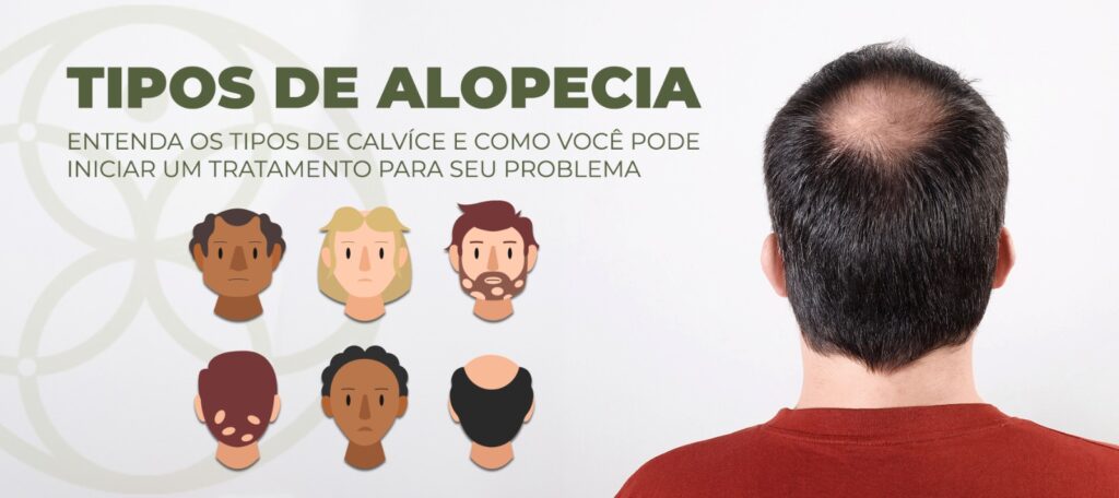 Calvície feminina: entenda os diferentes tipos e causas