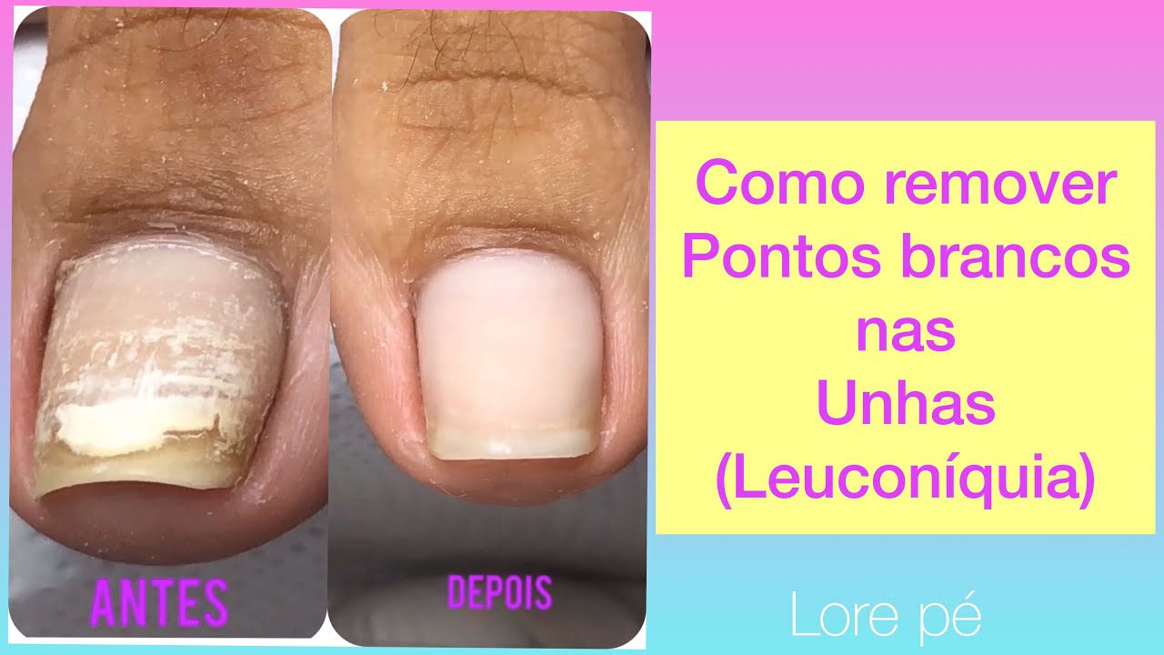 Pare de sofrer! Acabe com as manchas brancas nas unhas já