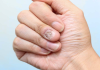 Unhas esbranquiçadas: Quando procurar um médico especialista?