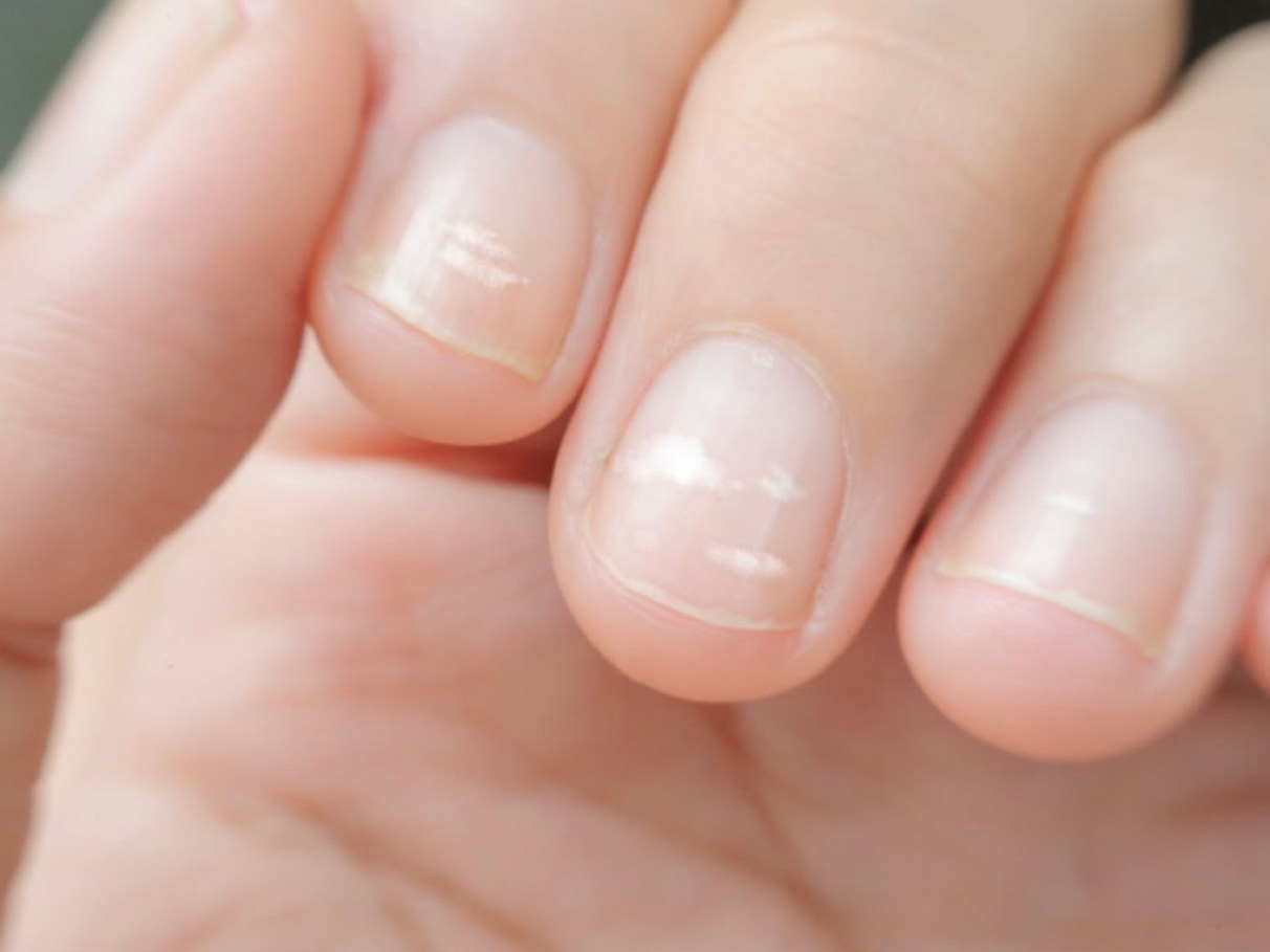 Unhas esbranquiçadas: Quando procurar um médico especialista?