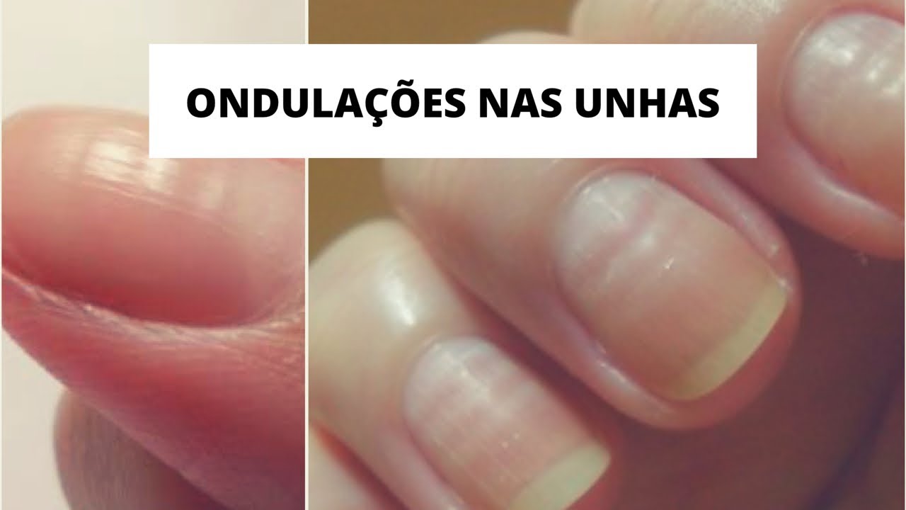 Você tem unhas com ondulações horizontais? Veja por que aparecem e o que fazer.