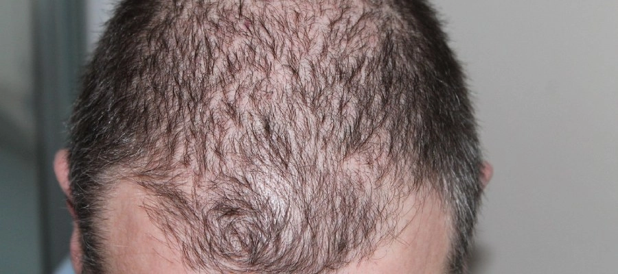 Queda de cabelo masculino: como evitar? (Experts dão o papo reto aqui!)