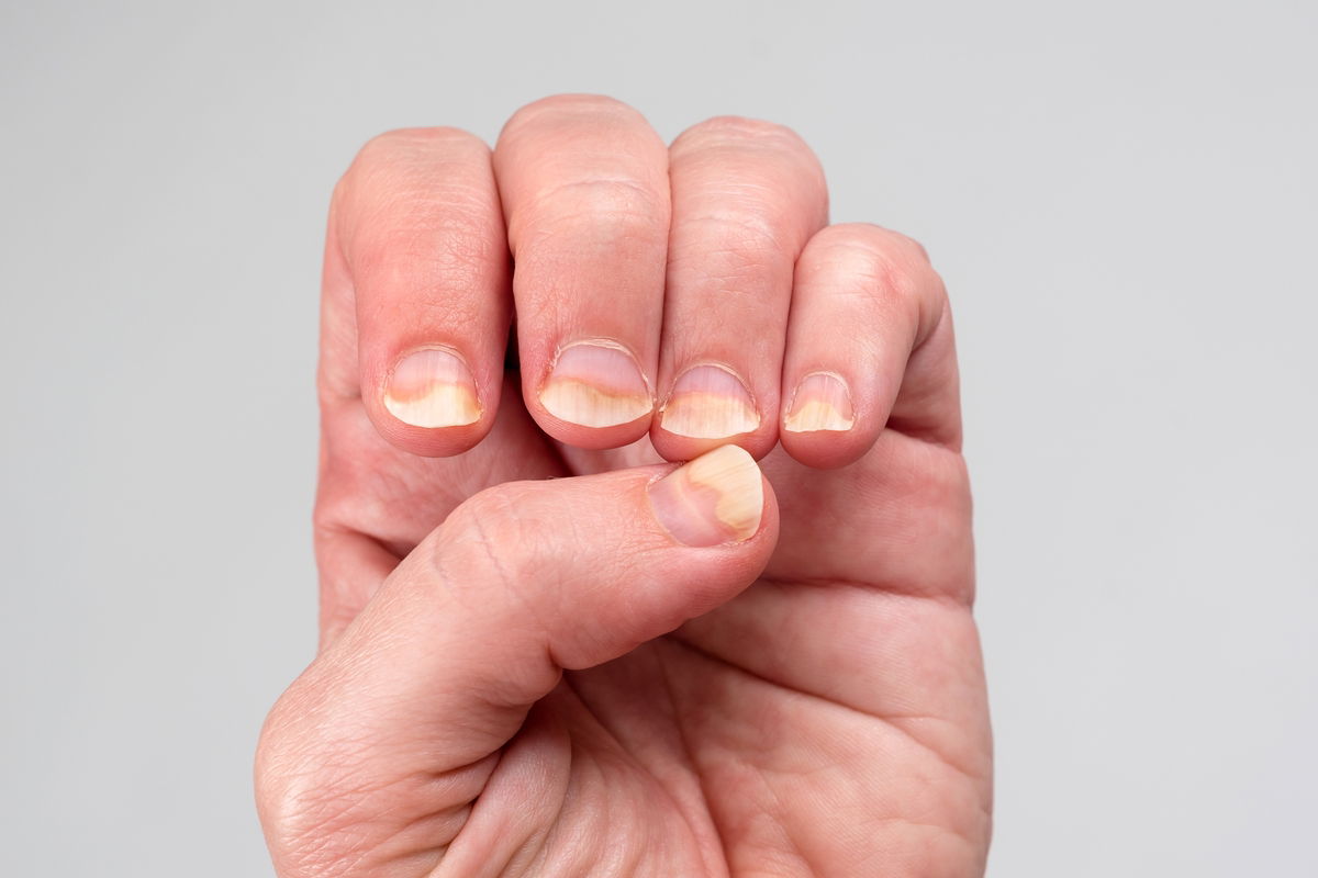 Você tem unhas com ondulações horizontais? Veja por que aparecem e o que fazer.