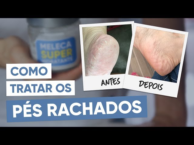 Rachadura nos pés tratamento caseiro 3 receitas fáceis e eficazes