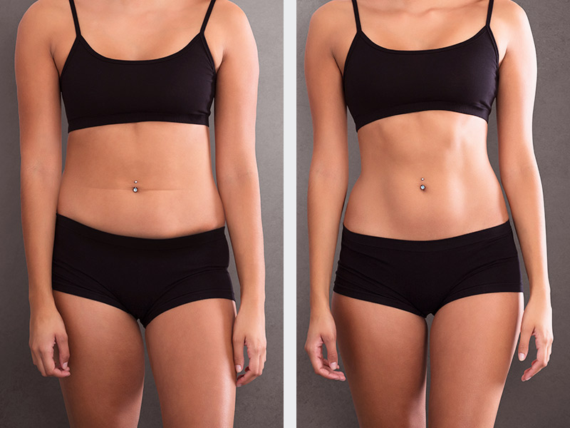 como usar lipo lad antes e depois para emagrecer rapido e com seguranca passo a passo!
