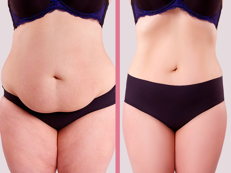 como usar lipo lad antes e depois para emagrecer rapido e com seguranca passo a passo!
