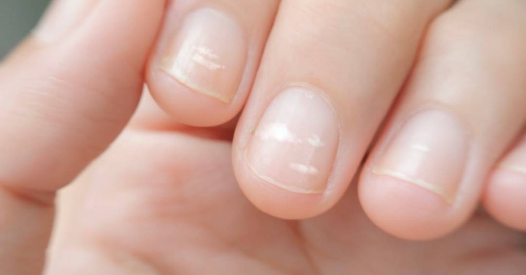 Unhas com mancha branca como evitar? 5 dicas práticas que funcionam!